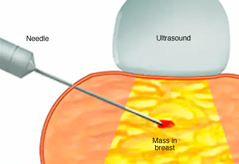 Core Needle Breast Biopsy - Chennai Breast Centre